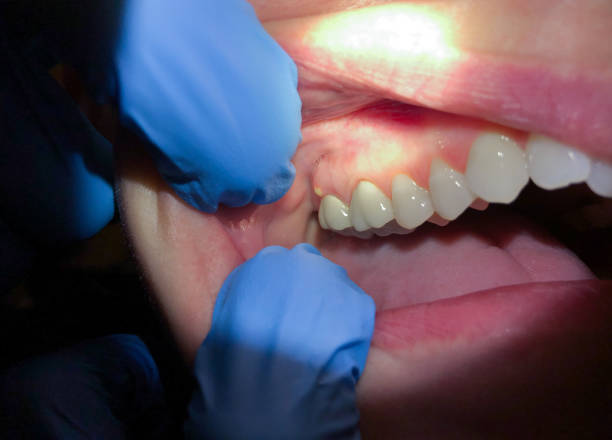 Best Emergency Treatment for Dental Infections or Abscesses in Carrollton, IL